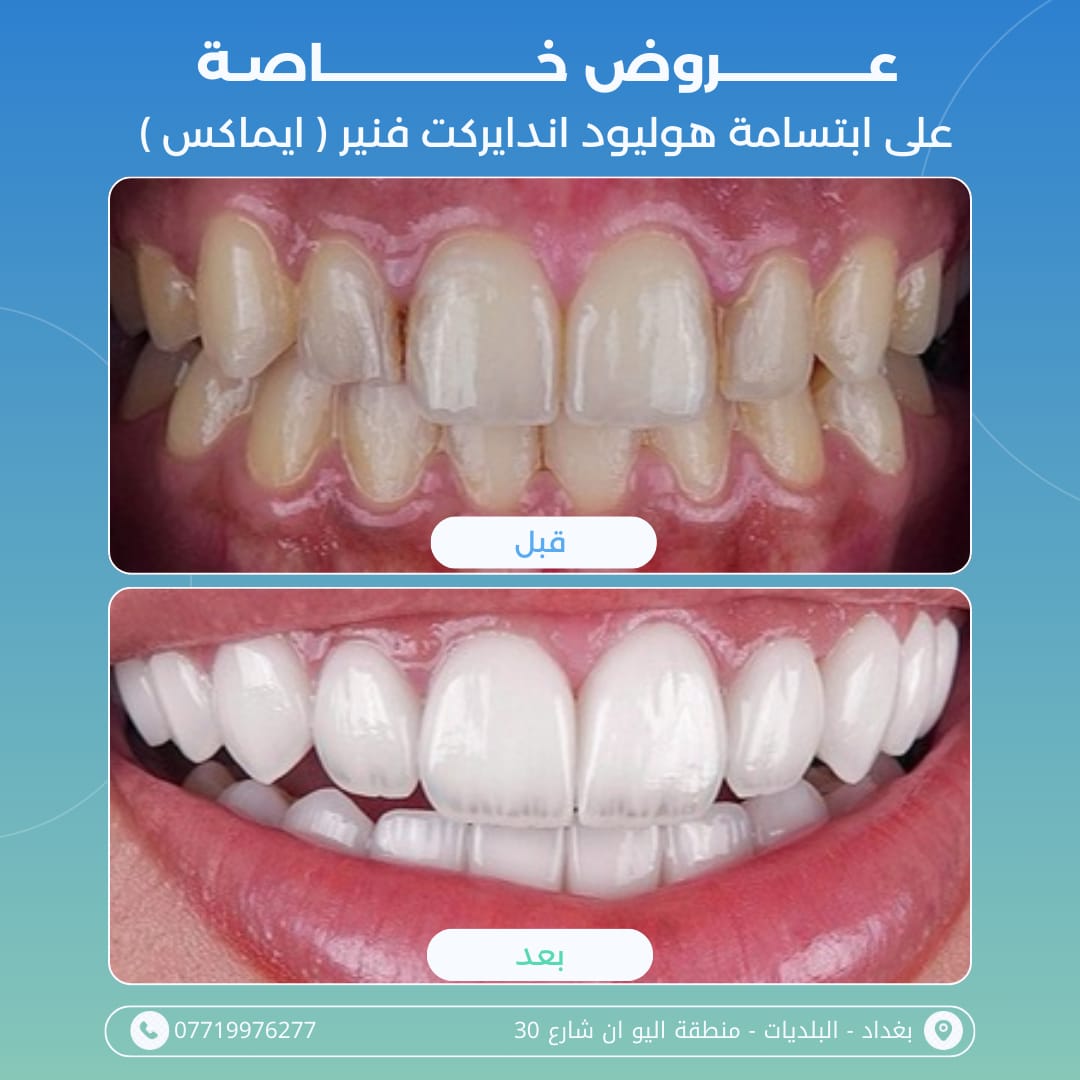 قشور الفينير