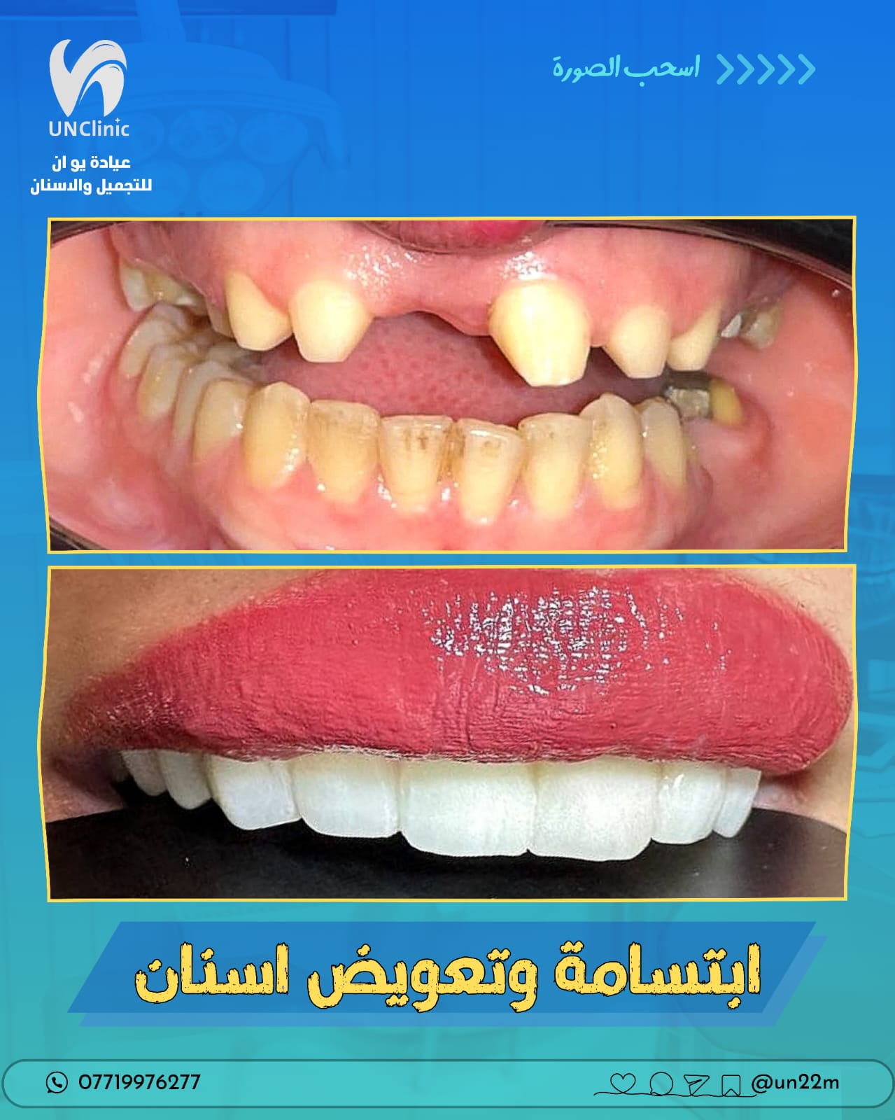 عملية تجميل